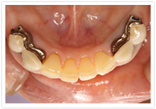 部分床入れ歯(アタッチメント)3